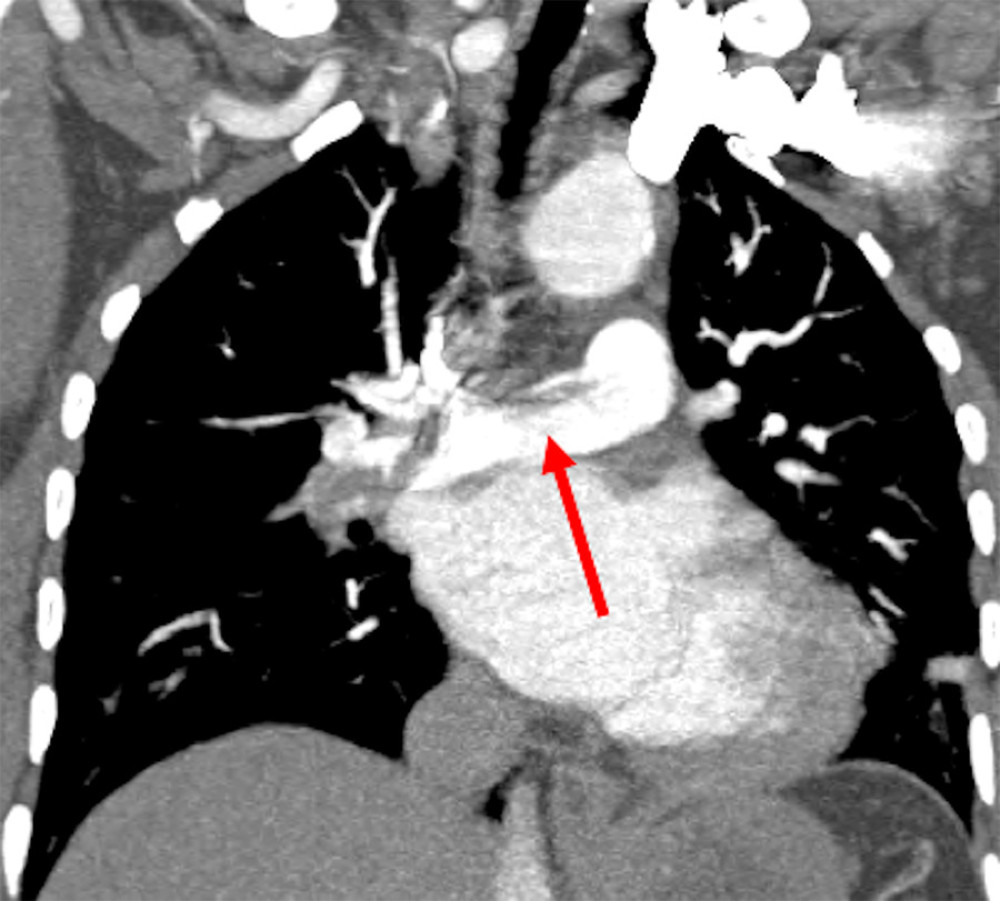 Coronal section CTPA demonstrating a linear branching filling defect in the pulmonary trunk bifurcation in keeping with saddle thrombus.