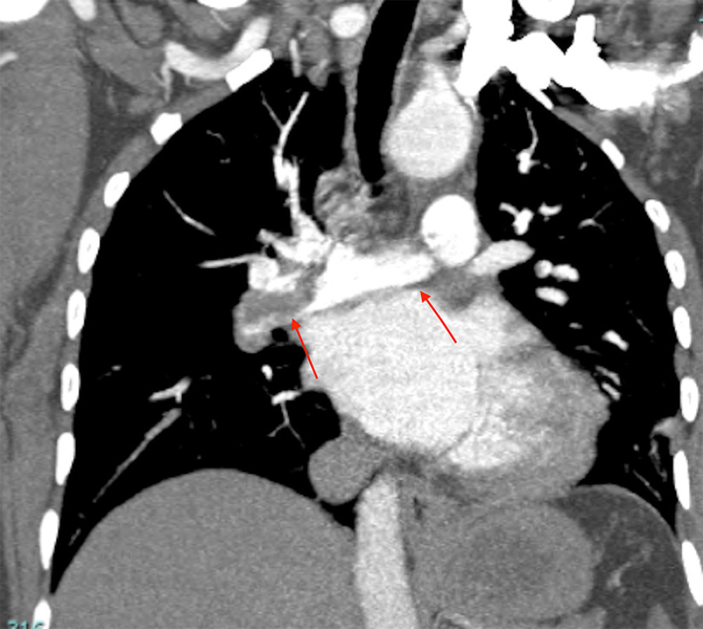 Coronal section CTPA illustrates extensive pulmonary emboli in the right main pulmonary artery and left main pulmonary artery.