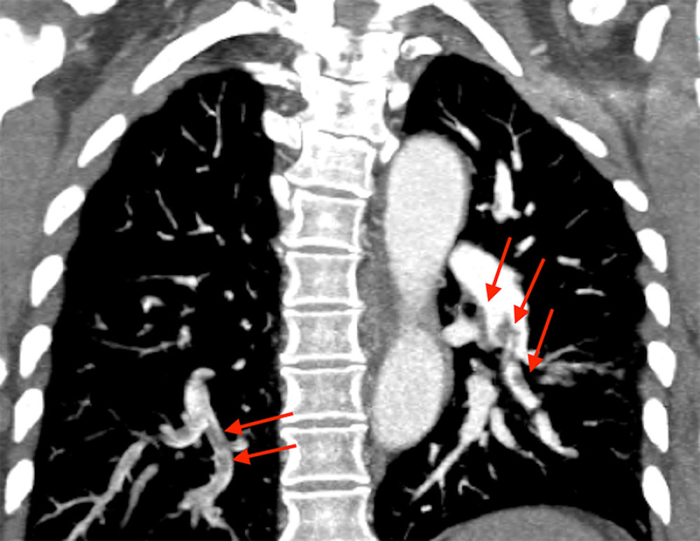 Coronal section CTPA shows extensive pulmonary emboli in segmental and subsegmental branches in both lower lobes.