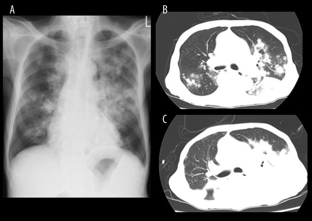 (A) Chest X-ray on admission. (B) Computed tomography on admission showed multiple nodules of variable sizes and consolidations with ground-glass attenuation in both lung fields. (C) A follow-up chest computed tomography on the 70th hospitalization day indicated remarkable progression of the lung lesions.
