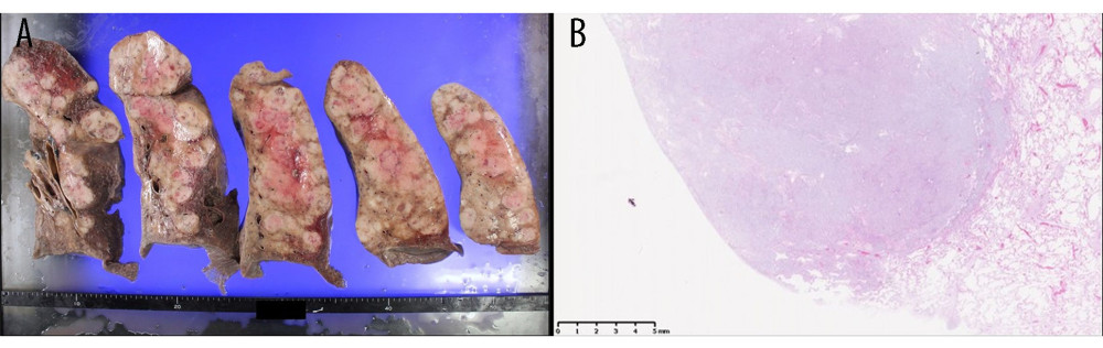 Pathological autopsy: Images of the lung specimen showed destroyed alveolar structures with neoplastic space-occupying lesions in both lungs: (A) Macroscopic images. (B) Microscopic images (scale bar 5 mm).