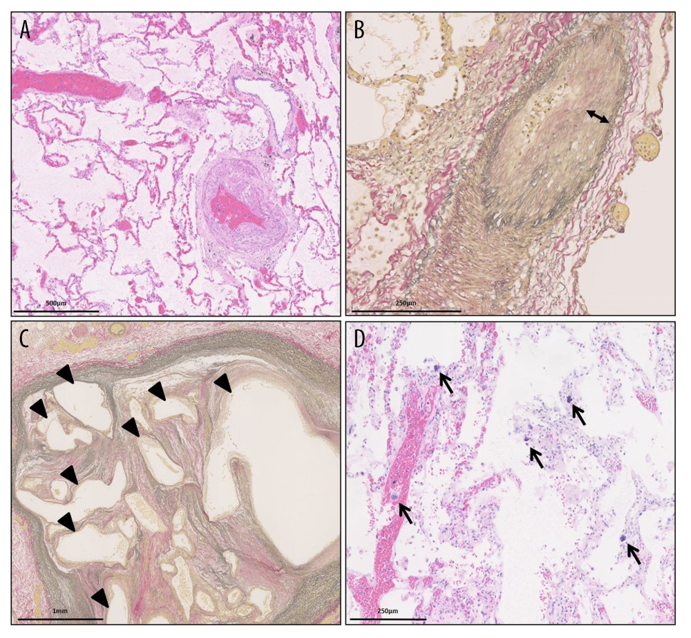 Microscopic findings in the pulmonary arteries: (A) Thickened walls of the pulmonary artery (hematoxylin-eosin stain) (scale bar 500 µm). (B) Elastica van Gieson staining showed intimal fibrosis (thin arrow) (scale bar 250 µm). (C) Elastica van Gieson staining showed thrombotic obstruction with recanalization (arrowheads) of the pulmonary arteries (scale bar 1 mm). (D) Megakaryocytes (thick arrows) seen in the lung tissue specimen (hematoxylin-eosin) (scale bar 250 µm).