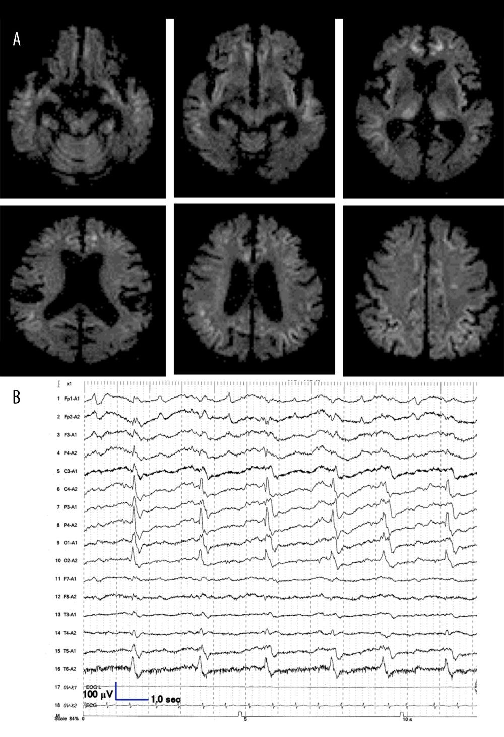 (A) Diffusion-weighted imaging of brain magnetic resonance imaging (MRI) at the time of the patient’s worst clinical condition. Diffuse hyperintensity lesions are seen in the cortices of bilateral frontal, parietal, and insular areas and in bilateral thalami. (B) Periodic sharp wave complexes (PSWCs) are noted on the electro-encephalogram. This was recorded at almost the same time as the MRI in A above.