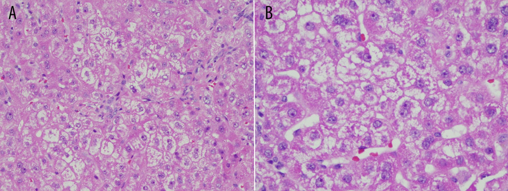 Liver histology pretreatment with PCSK9 inhibitor in 2019 showing (A) ballooning degeneration of hepatocytes and (B) Mallory hyaline, which is a characteristic of cytoplasmic hyaline inclusion in hepatocytes and thus resemble a peculiar manifestation of liver cell injury. (Hematoxylineosin staining, original magnification ×200).