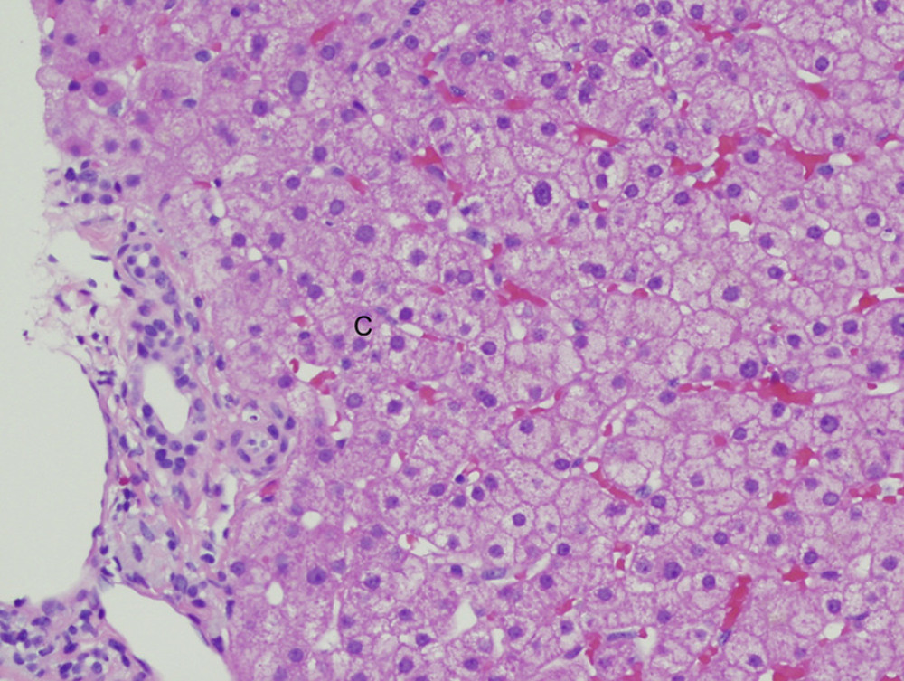Liver histology after PCSK9 inhibitor treatment in 2020 showing (C) normal liver parenchyma (hematoxylineosin staining, original magnification ×200).