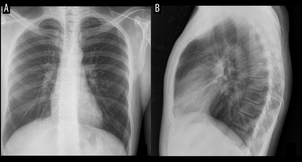 Chest X-rays performed in April 2019 show no abnormalities. (A) Posteroanterior view. (B) Lateral view.