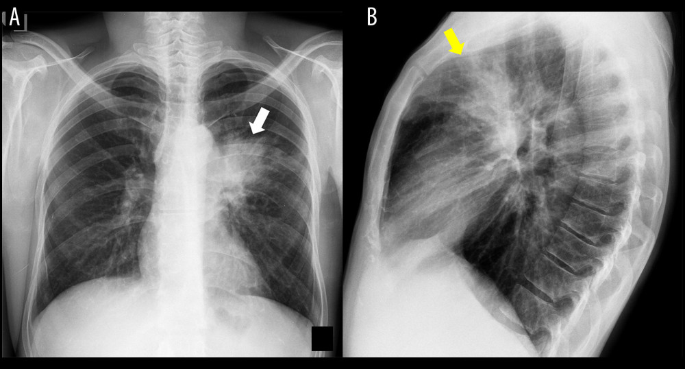 Chest X-rays performed in July 2019. Consolidation of the pulmonary parenchyma and obscuring of the left hilum (white arrow), with air-space opacification in the anterior segment of the left upper lobe (yellow arrow), is visible in the posteroanterior (A) and lateral views (B).
