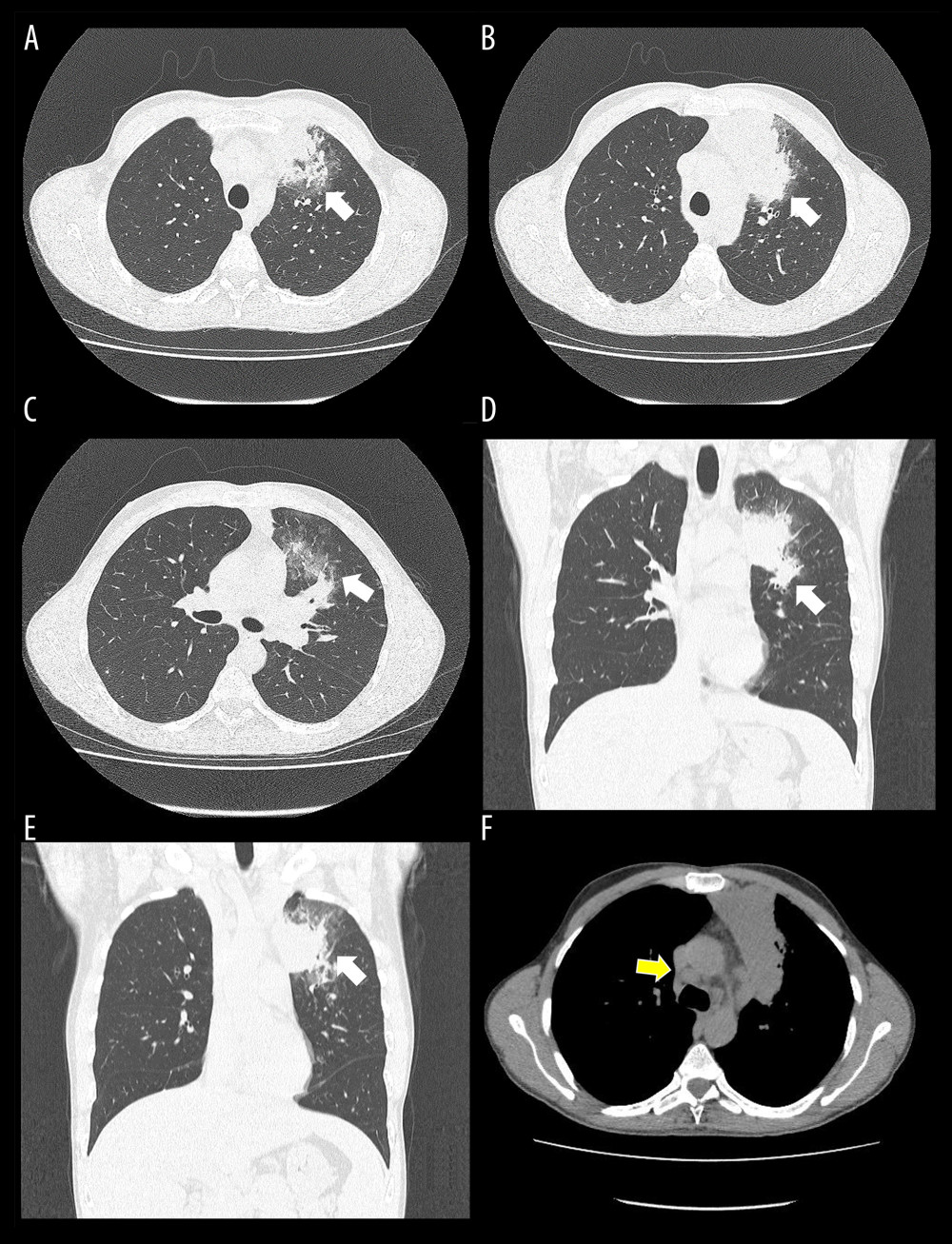 Thoracic computed tomography performed in August 2019. In the lung window, axial (A–C), and coronal slices (D, E), patchy areas of consolidation and nodules with surrounding ground-glass opacities in the medial portion of the anterior segment of the left upper lobe (white arrows) are visible. Random pulmonary micronodules are visible in the lung window (A–E), and lymphadenopathy (yellow arrow) is seen in the axial slide of the mediastinal window (F). These findings are consistent with a pulmonary infection.