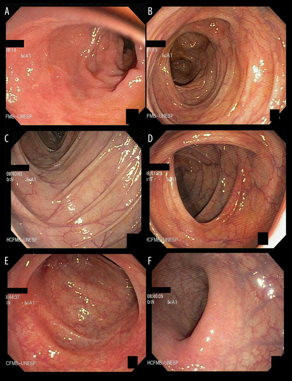 Ileocolonoscopy performed in November 2020 shows no abnormalities. (A) Terminal ileum. (B) Ascending colon. (C, D) Transverse. (E) Sigmoid. (F) Rectum.