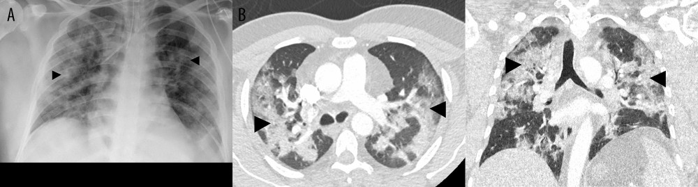 Supine chest X-ray immediately after intubation and computed tomography (axial/coronal) on admission (A, B) showing typical bilateral infiltrates and beginning of fibrosing alveolitis (black arrows).