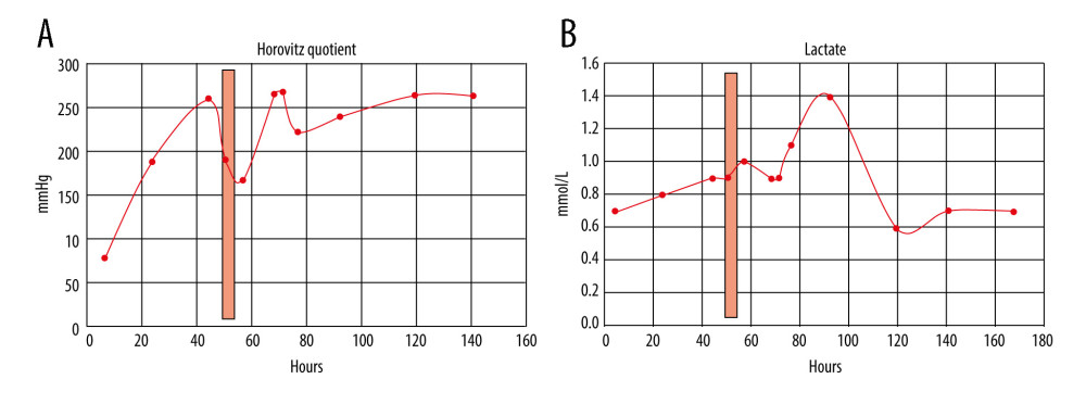 (A) CRP apheresis (light red column) and course of Horovitz quotient [16]. Horovitz quotient changed from severe (PaO2/FIO2 ≤100 mmHg) to moderate (PaO2/FIO2 ≤200 mmHg) after intubation and ventral positioning, then worsened during CRP apheresis due to dorsal positioning. After CRP apheresis, however, Horovitz quotient, independent from dorsal or ventral positioning, significantly improved until extubation and hospital discharge. (B) CRP apheresis (light red column) and course of lactate (reference range 0.5–1.6 mmol/L). Lactate remained normal during the hospital stay.