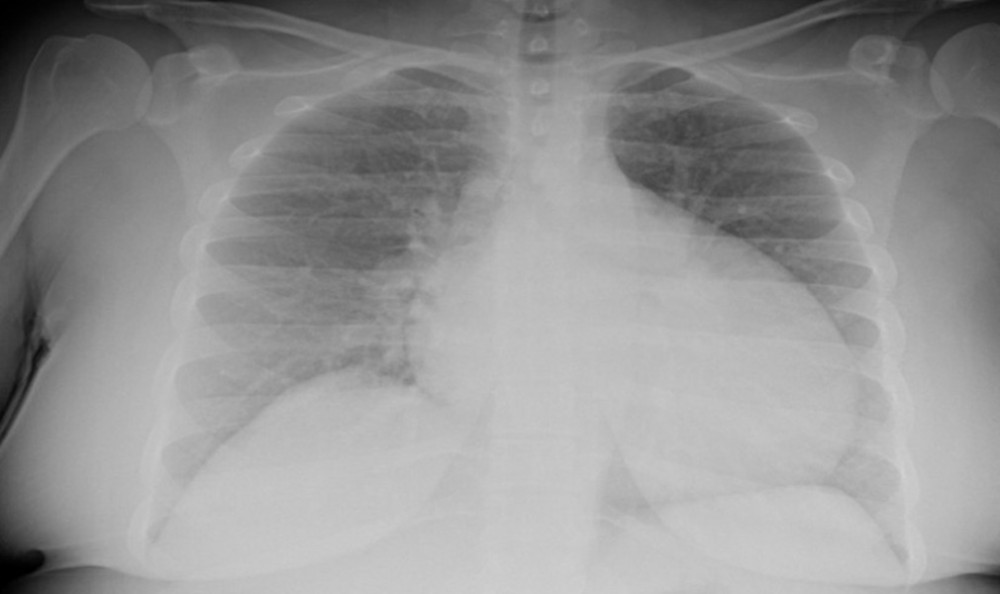 Chest X-ray indicating cardiomegaly with low-grade pulmonary congestion. Pericardial effusion cannot be excluded.