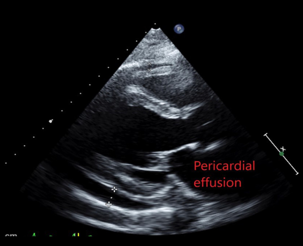 Transthoracic ultracardiography showing pericardial effusion.