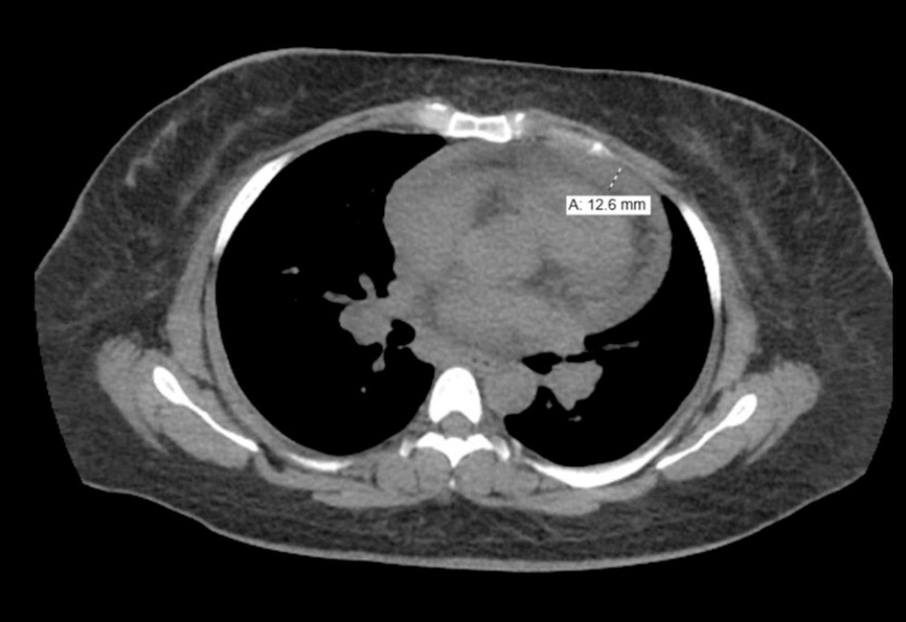 CT chest abdomen and pelvis representing 12.6-mm pericardial effusion, indicated by arrow.