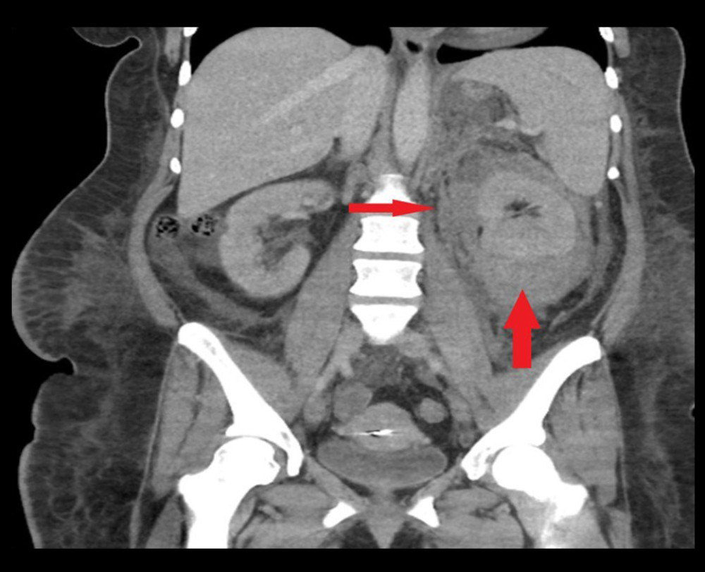 CT abdomen and pelvis with contrast revealing large left perinephric hematoma and retroperitoneal stranding, indicated by arrow.