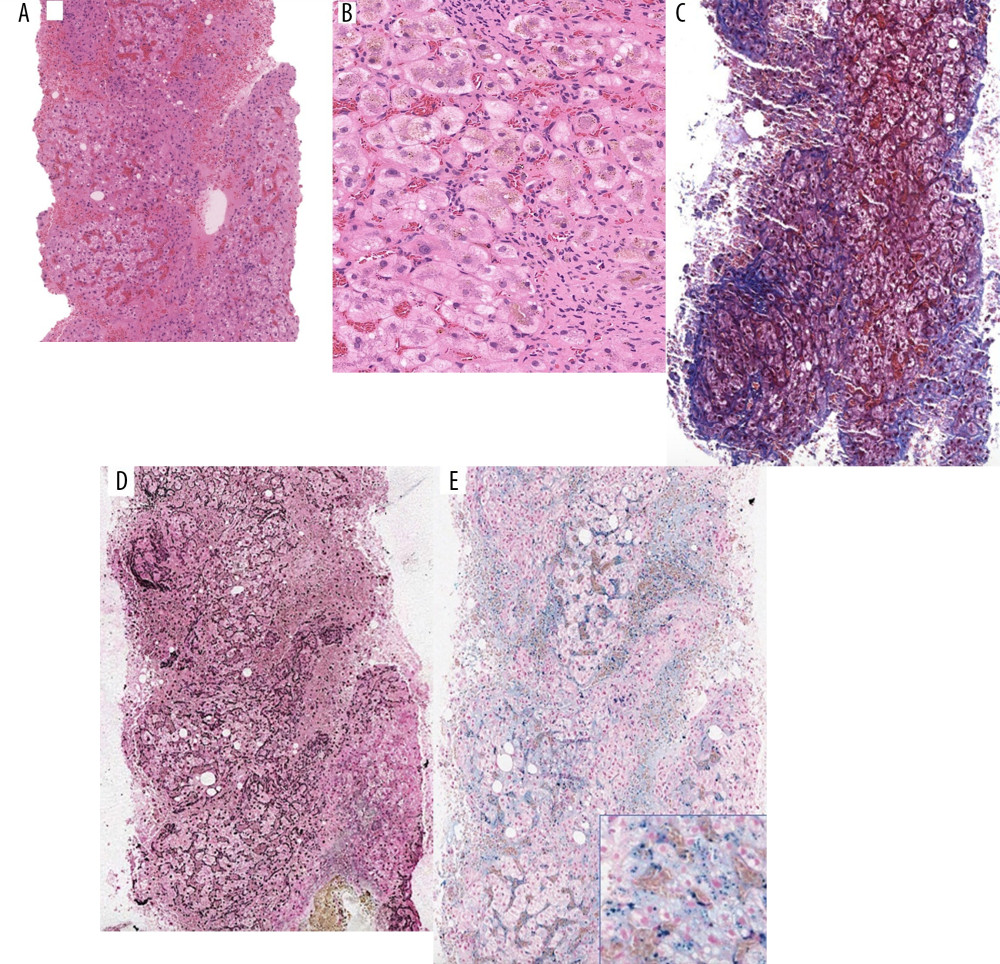 (A, B) H&E sections of liver show micronodular cirrhosis with intracellular accumulation of brown hemosiderin pigment. (C) Trichrome staining demonstrates evidence of hepatic fibrosis. (D) Reticulin staining illustrates the nodular appearance of regenerating liver nodules typical of cirrhosis. (E) Perls staining demonstrates extensive deposition of hemosiderin (blue) pigment in liver tissue.