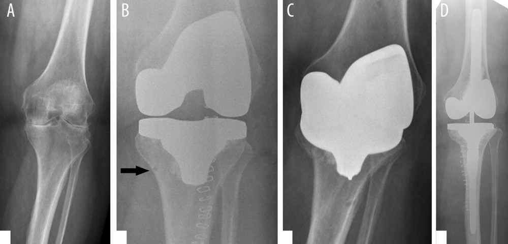 Case 1 X-rays. (A) Pre-op, (B) Immediately postoperatively. The cutting block pinhole is clearly seen adjacent to the medial tibial cortex (arrow). (C) Six weeks postoperatively, with fracture through the pinhole and collapse into varus. (D) Postoperative revision.