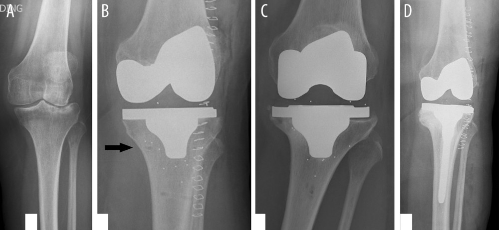 Case 2 X-rays. (A) Pre-op, (B) Immediately postoperatively, with cutting block pinhole adjacent to the medial tibial cortex (arrow), (C) One year postoperatively, with varus angulation at the level of the medial pinhole. (D) Postoperative revision.