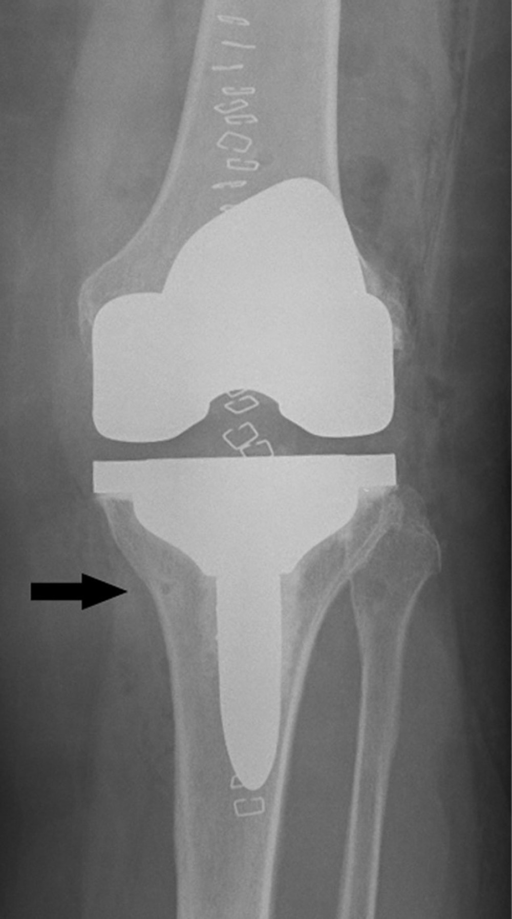 At-risk tibia identified intraoperatively and managed with prophylactic cemented stem.