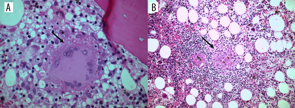Bone marrow biopsy. (A) Langhans-type giant cell in a paratrabecular position (arrow) (HE ×400). (B) A collection of histiocytes forming a non-caseating granuloma in the center (arrow) (HE ×100).