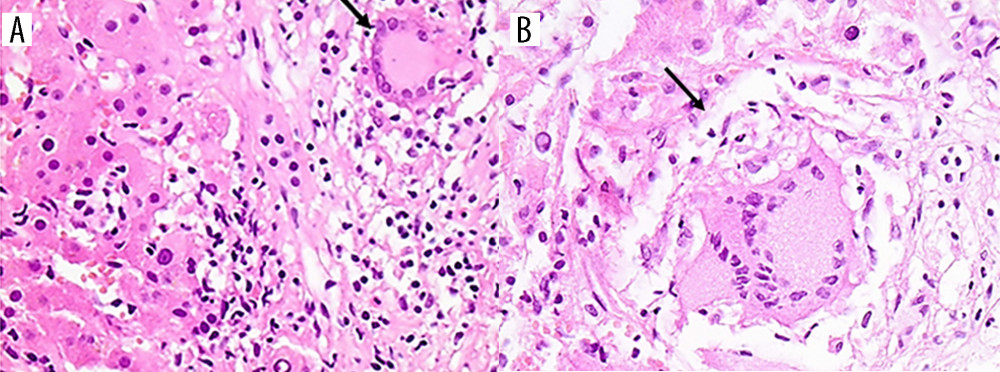 Liver biopsy. (A) Small histiocytic granuloma with a Langhans-type giant cell in a portal tract (arrow). Mild portal inflammation is also evident (HE ×200). (B) Small histiocytic granuloma with a Langhans-type giant cell located in the parenchyma (arrow) (HE ×400).