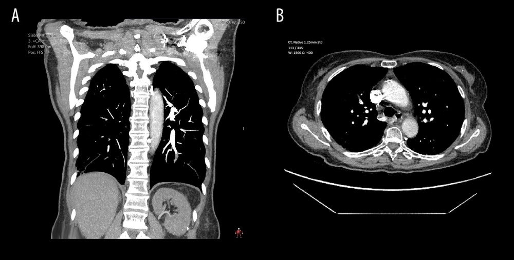 Coronal (A) and axial (B) thoracic computed tomography angiography slices on admission. PACS system Sectra Workstation IDS7 Version 21.2.