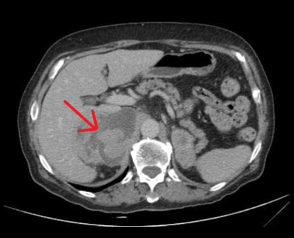 CT scan. Staging CT scan showing a large adrenal metastasis (indicated by the red arrow).