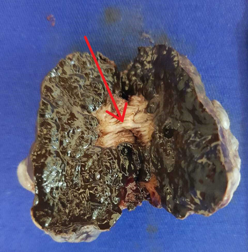 Surgical specimen. Picture of the open surgical specimen showing a partial resection of the anal sphincter, indicated by the red arrow.
