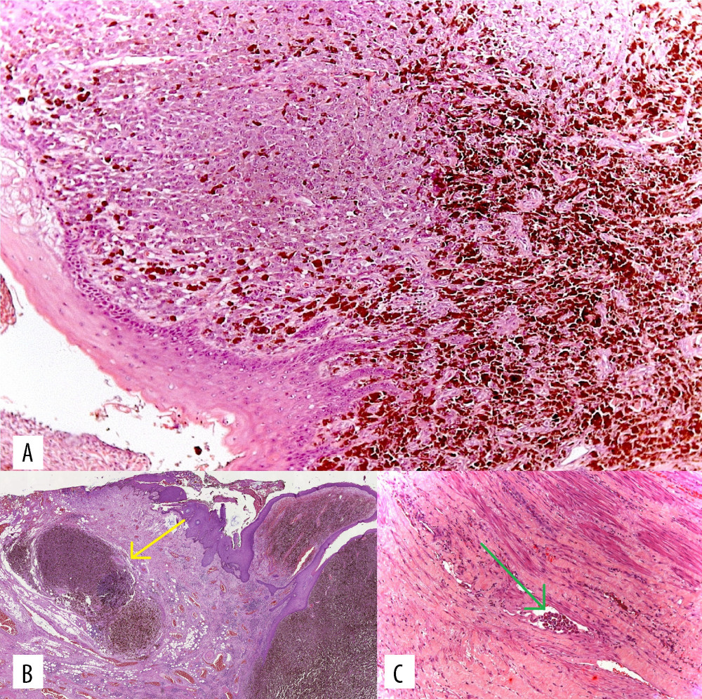 Histopathology. Histopathological evaluation demonstrating anorectal melanoma (A); with microsatellitosis (B, indicated by the yellow arrow), and vascular invasion (C, indicated by the green arrow).