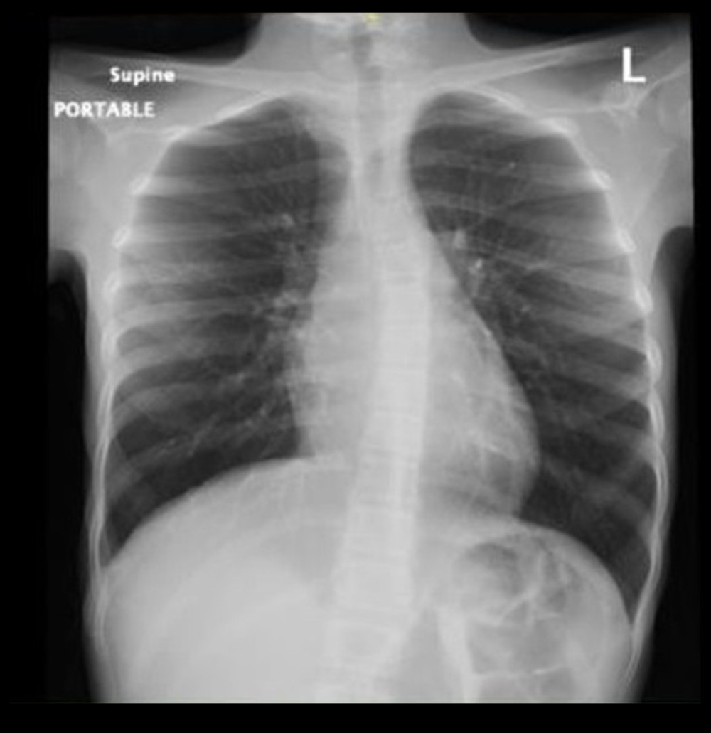 Chest X-ray on admission. Both lung fields are over-aerated. No parenchymal consolidation or ground-glass opacities in either lung field. Normal chest X-ray finding.