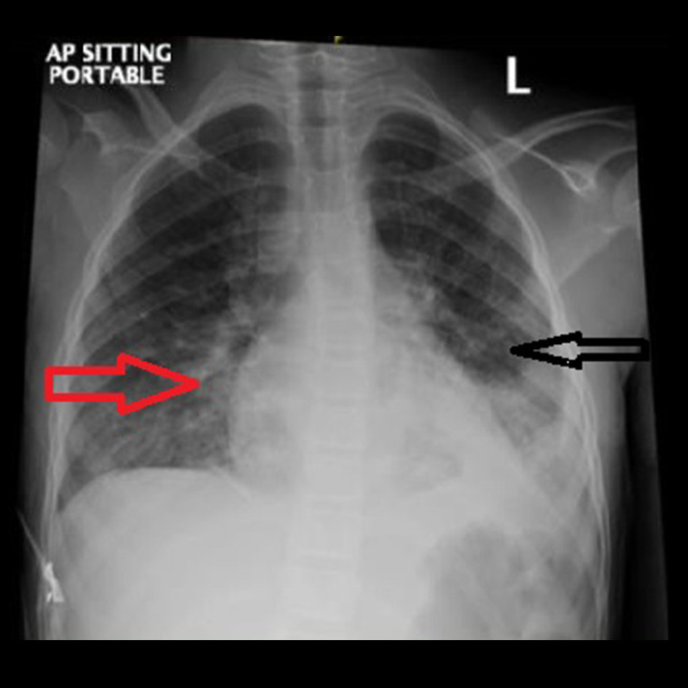 Chest X-ray 12 h after admission, showing moderatesize patchy area of consolidation in the left lower lobe. Also, there is an area of glass-ground opacity and consolidation noted in the right lower zone medially, suggestive of bronchopneumonia.