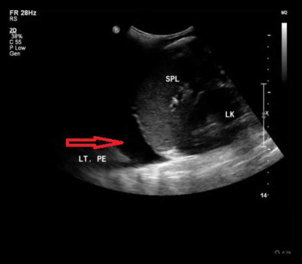 Left subdiaphragmatic longitudinal view ultrasonography, showing a moderate left pleural effusion with collapsed left lung.