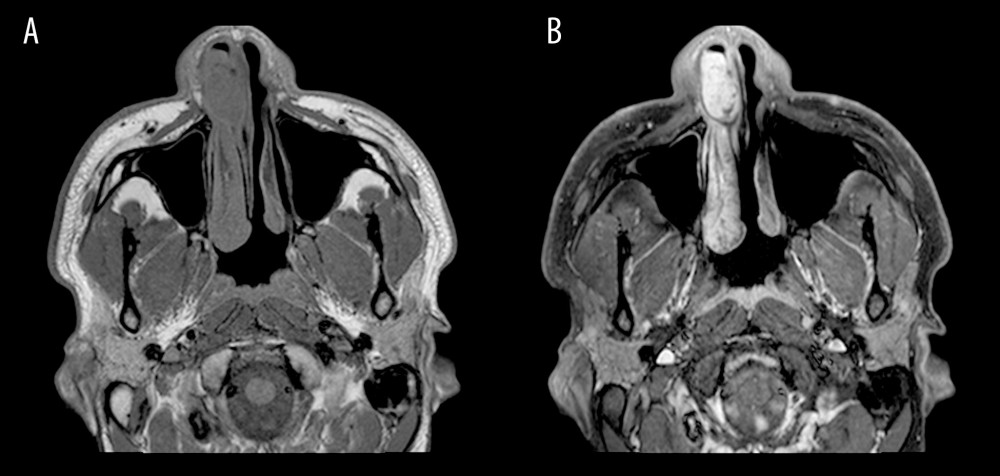 Axial T1-weighted pre contrast (A) and post contrast (B) images show a mass centered at the right nasal vestibule intimately associated with the nasal septum and lateral nasal wall. Post-contrast administration, the mass showed enhancement.