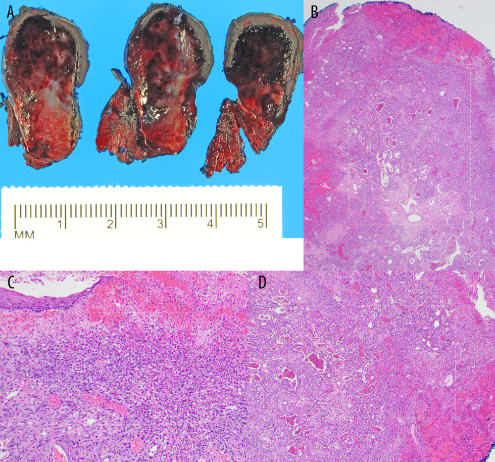 Sections of the mass showing tan-brown to dark red, hemorrhagic, spongy parenchyma with tan-white fibrous tissue (A). Low magnification showing superficial mucosal ulceration with hemorrhage and granulation tissue, deep lobular proliferation of capillaries with central dilated vessels, separated by fibrous bands (Hematoxylin and Eosin) (B). Higher magnification showing ulceration of respiratory mucosa with hemorrhage, granulation tissue, and inflammation, (Hematoxylin and Eosin) (C). Lobular proliferation of capillaries with central dilated larger vessels (Hematoxylin and Eosin) (D). (Microsoft Photos, Version 2020.20120.4004.0, Microsoft).