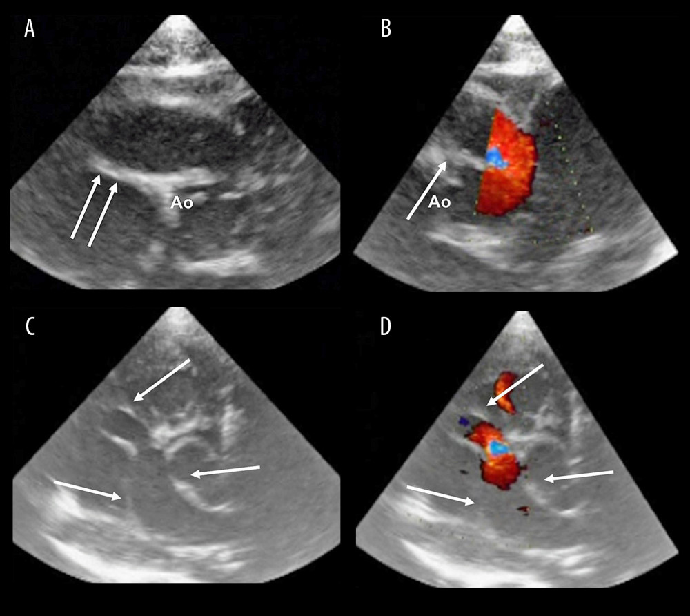 Transthoracic echocardiograms. (A, B) Parasternal short-axis views. (C, D) Subxiphoid views. Arrows: Proximal right coronary artery markedly dilated. Ao – aorta. (Adobe Photoshop Elements 18.0).