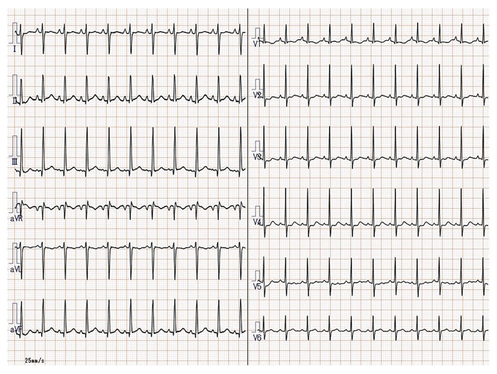 Electrocardiogram. There were no abnormal Q waves or ST-T changes in leads II, III, and aVF. (Adobe Photoshop Elements 18.0).