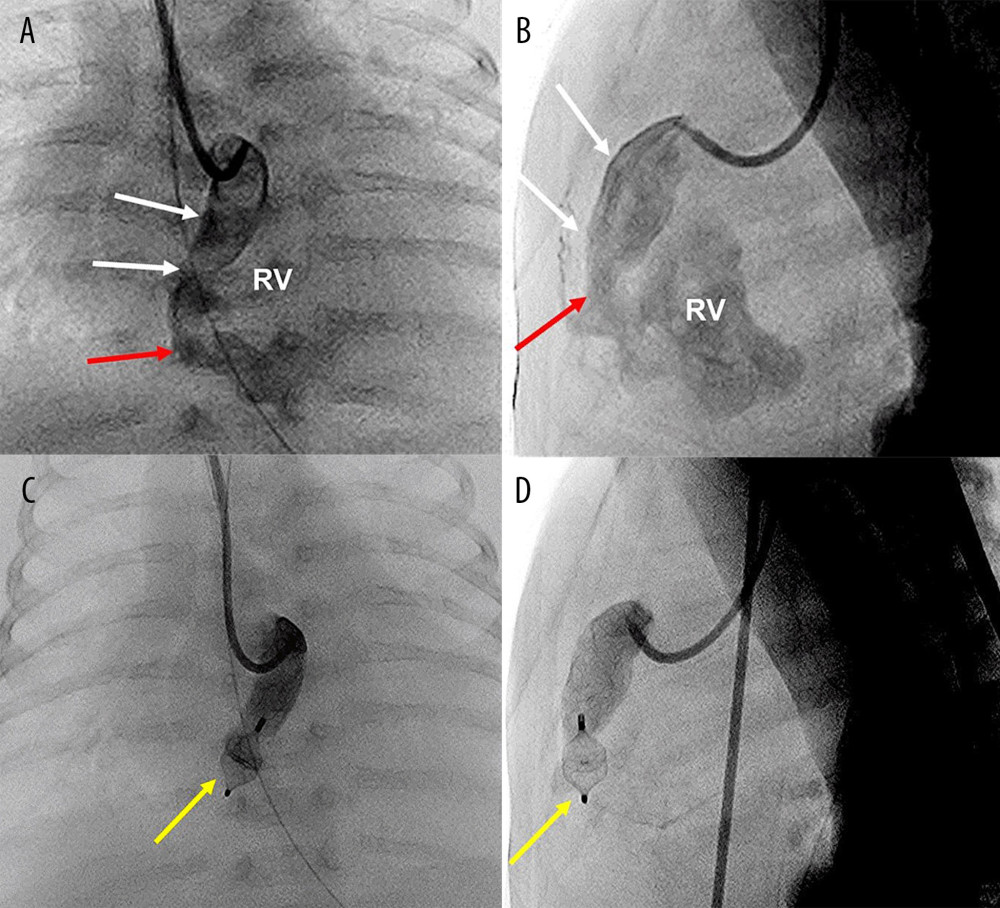 Right coronary angiography. Pre-procedure: Frontal (A) and lateral projections (B); Proximal right coronary artery (white arrows) was markedly dilated. The “neck” of the fistula (red arrows) was defined proximal to it, entering the right ventricle (RV). Post-device deployment: Frontal (C) and lateral projections (D); A self-expandable device (yellow arrows) was deployed at the neck of the fistula. (Adobe Photoshop Elements 18.0).