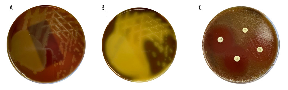 Viridans streptococci on (A) blood agar and (B) chocolate agar plates; alpha hemolysis (partial or green discoloration), minute to small, gray, convex shaped, smooth, or matte colonies. (C) Disc diffusion plate of antibiotics susceptibility on blood agar; resistant to optochin disk, sensitive to vancomycin, ceftriaxone, and oxacillin.