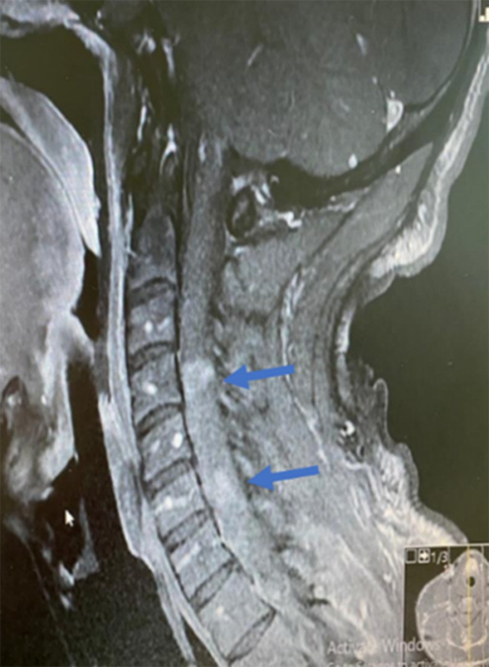 Preoperatively, showing 2 cervical masses in C4 and C6 (arrows).