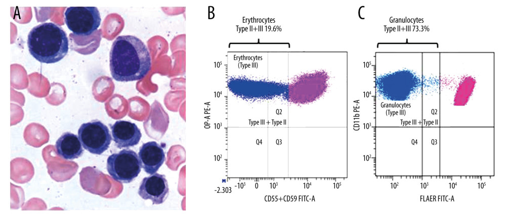 (A) The bone marrow findings from the bone marrow aspiration (×600, hematoxylin and eosin staining). Erythroid hyperplasia with megaloblastic change was observed. (B) Erythrocyte paroxysmal nocturnal hemoglobinuria (PNH) clones. Erythrocyte PNH clones are expressed as the total of Type II (partial deficiency) and Type III (complete deficiency) clones. (C) Granulocyte PNH clones. Granulocyte PNH clones are expressed as the total of Type II (partial deficiency) and Type III (complete deficiency) clones.