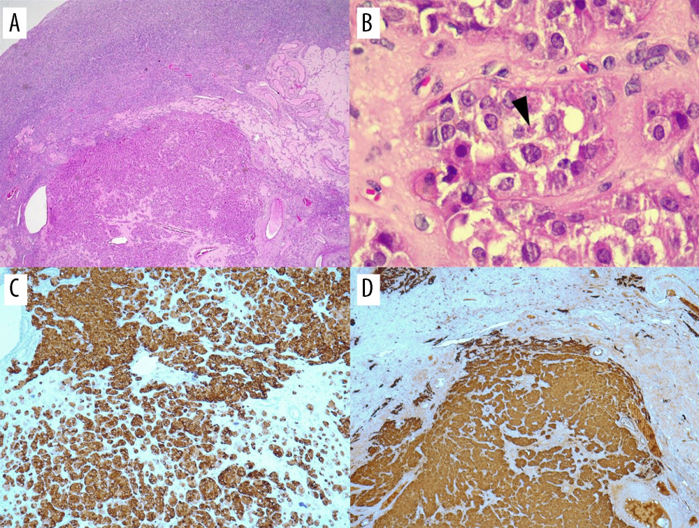 Histopathological images. (A) Hematoxylin-eosin staining showing the tumor. (B) Arrowhead showing Reinke crystalloids. (C) Positive staining of tumor cells for calretinin (20). (D) Positive staining of tumor cells for inhibin (20).