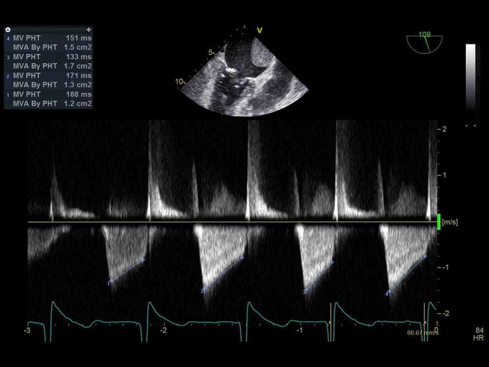 Transesophageal echocardiography, mid-esophageal long-axis view of mitral valve showing mitral leaflets and mitral valve area by pressure-half time.