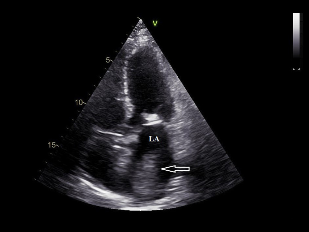 Transthoracic echocardiography, apical four-chamber view. Intra-atrial thrombus (arrow) in the left atrium (LA).