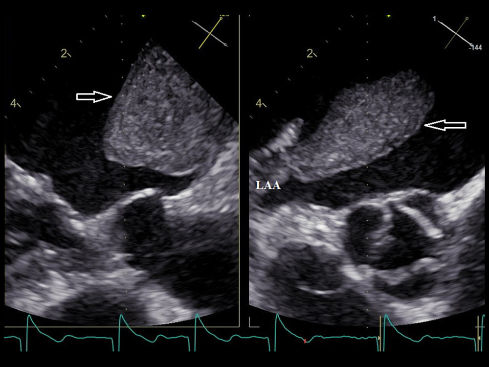 Transesophageal echocardiography, mid-esophageal view. Intra-atrial thrombus (arrow).