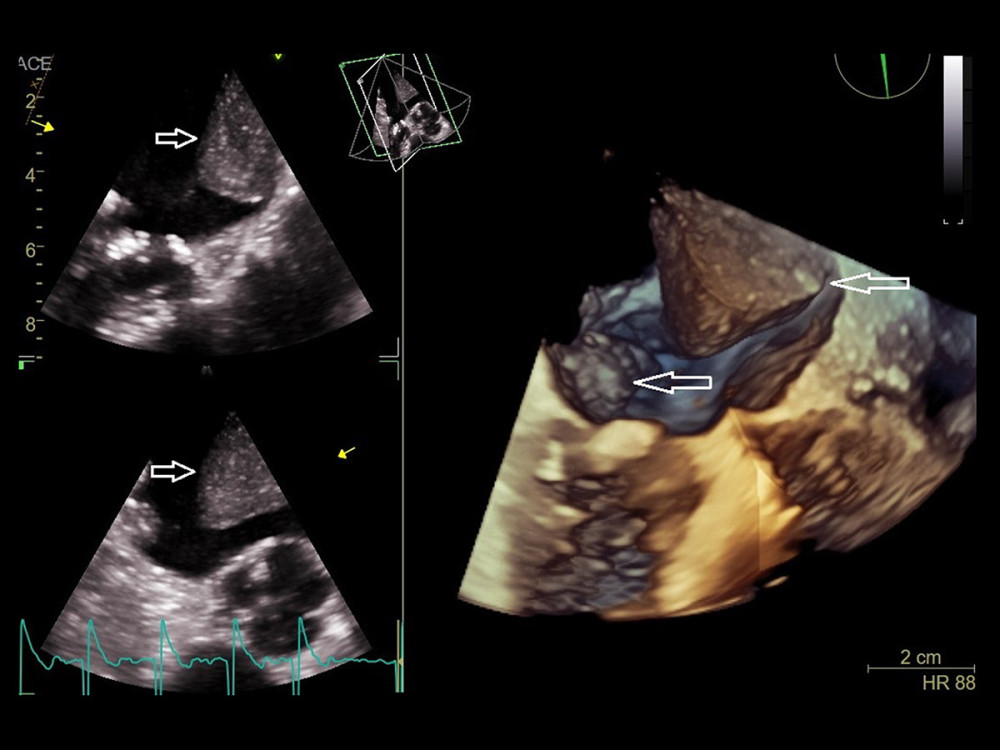 Two- and three-dimensional transesophageal echocardiography, mid-esophageal view. Intra-atrial thrombus (arrow).
