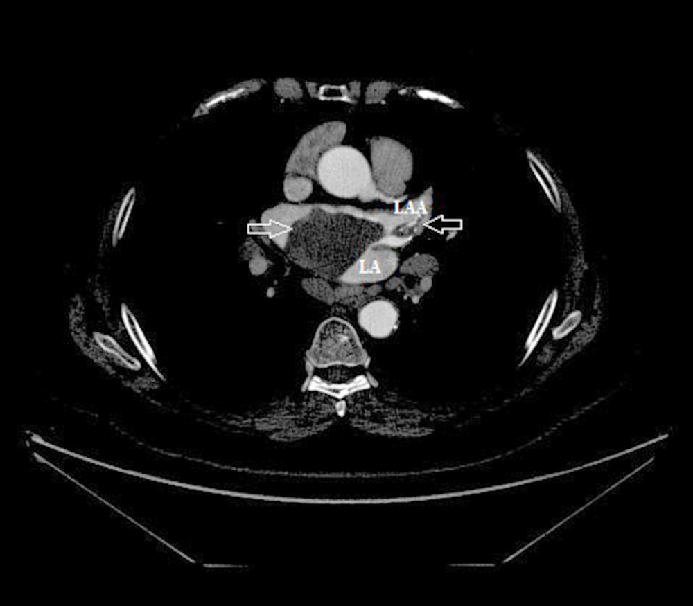 Contrast-enhanced computed tomography. Thrombus (arrow).