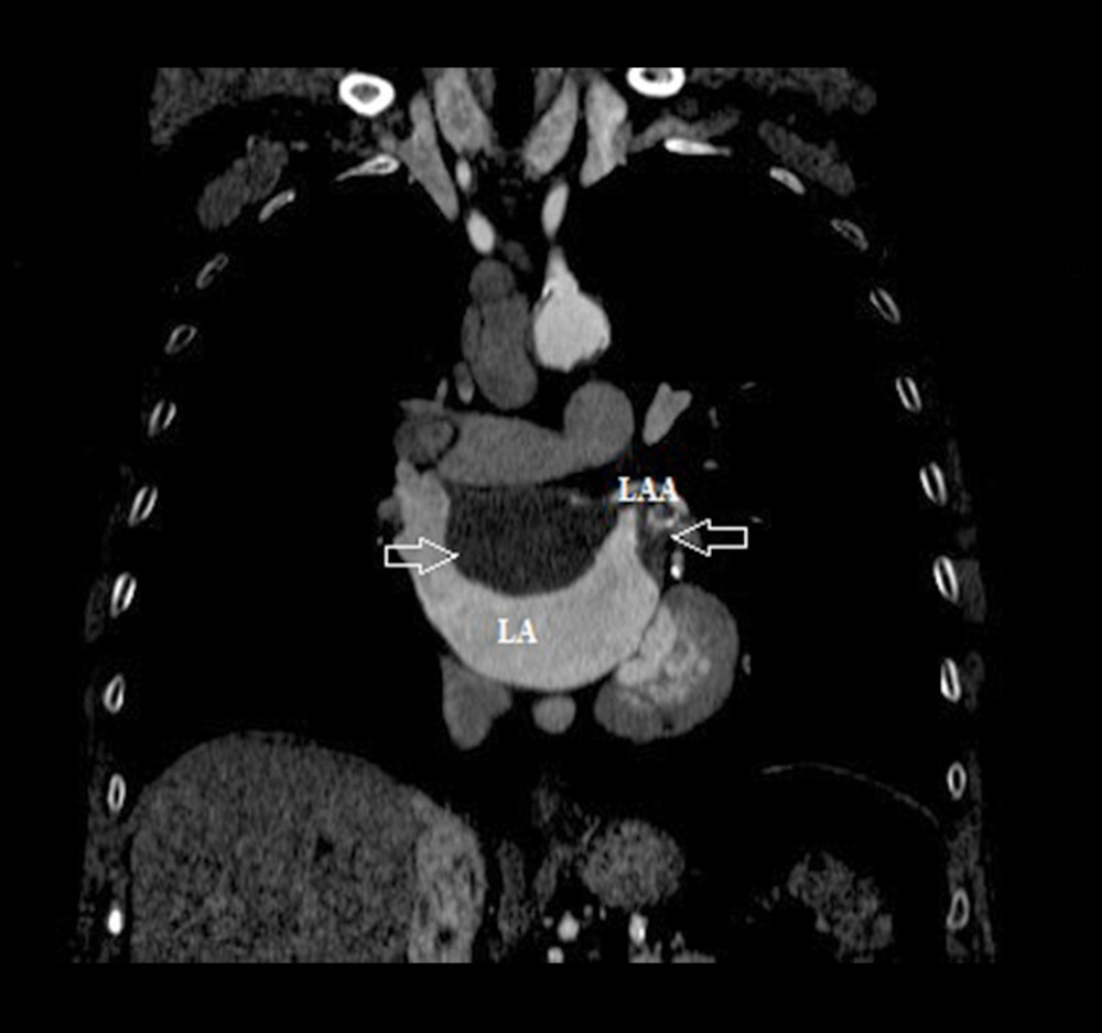 Contrast-enhanced computed tomography. Thrombus (arrow).