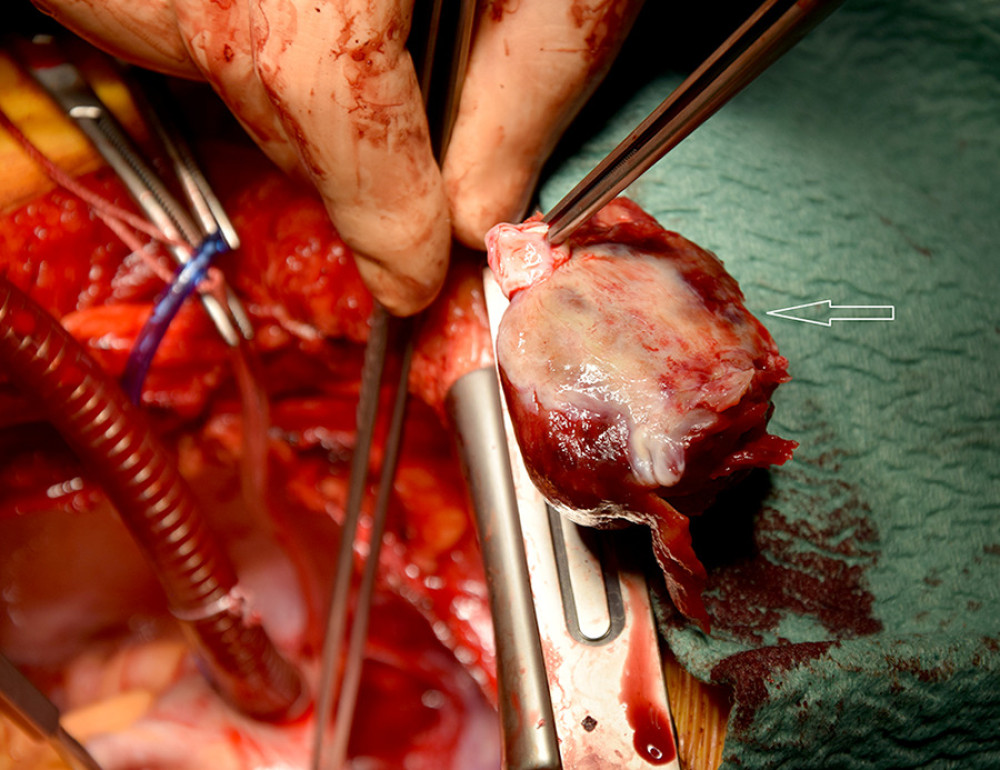 Intraoperative view of the excised abnormal mass (arrow).