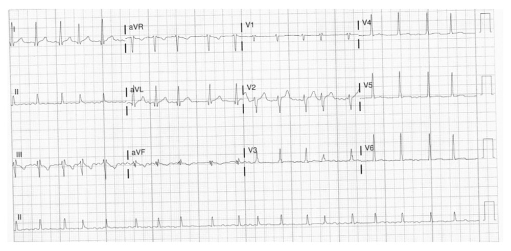 Case 1: EKG of the 29-year-old son on hospital admission in 2020. It shows atrial fibrillation with a heart rate of 109 beats per min.