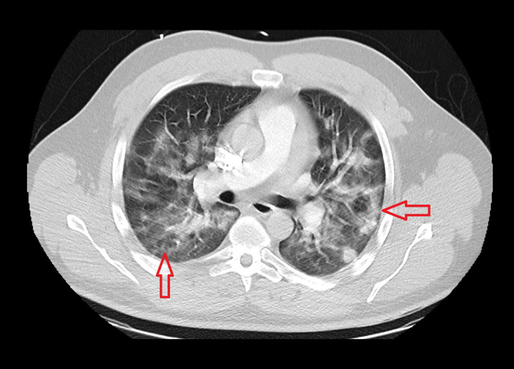 Case 1: Chest computed tomography scan of the 29-year-old son on hospital admission in 2020. It shows extensive bilateral ground-glass opacities.